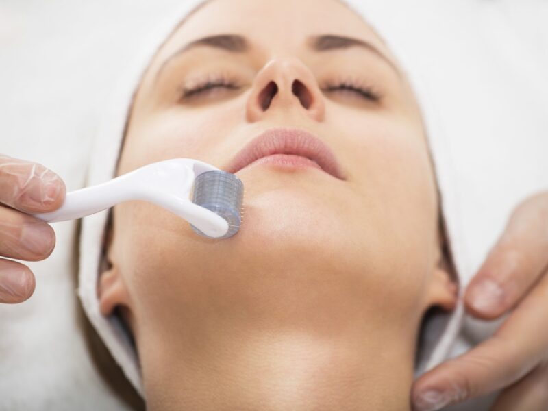 Effortless Radiance: Why Microneedling Rollers Should Be Part of Your Skincare Routine in 2023